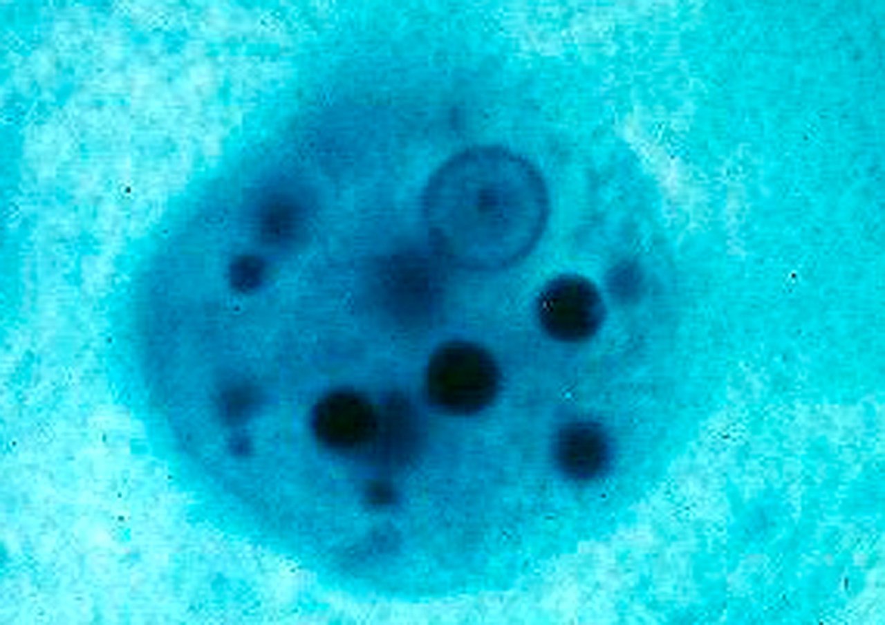 Entamoeba histolytica forma magna (с фагоцитированными эритроцитами)